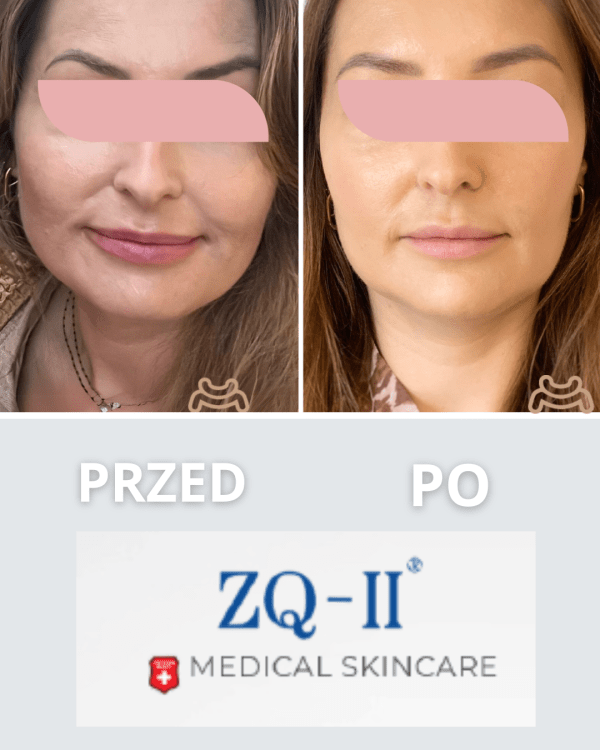 ZQ-II PLLA Nutrients Folls 3x5ml - kwas polimlekowy w ampułkostrzykawkach - obrazek 3