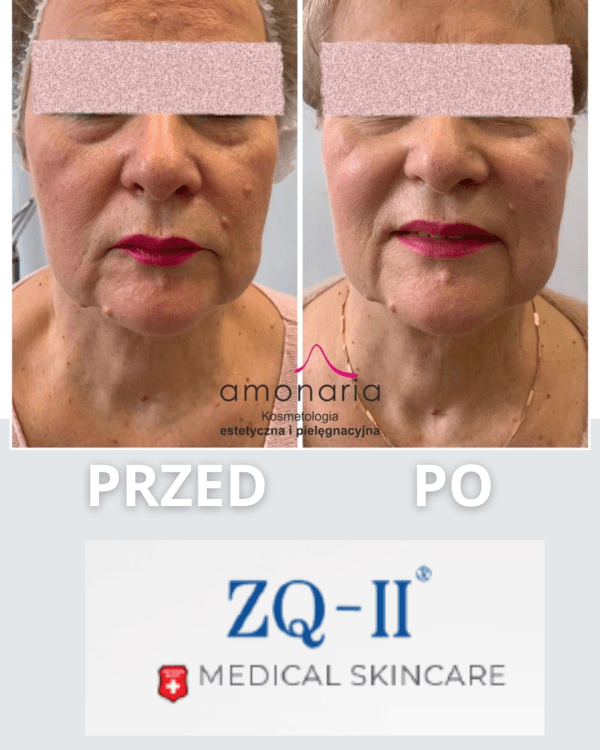 ZQ-II PLLA Nutrients Folls 3x5ml - kwas polimlekowy w ampułkostrzykawkach - obrazek 2
